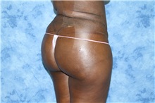 Liposuction After Photo by Wendell Perry, MD; Doral, FL - Case 27774