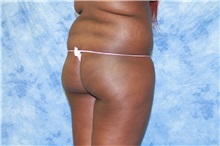 Liposuction Before Photo by Wendell Perry, MD; Doral, FL - Case 27774