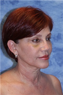 Dermal Fillers After Photo by Wendell Perry, MD; Doral, FL - Case 27776