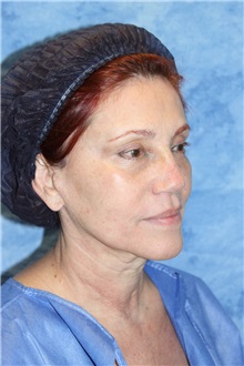 Dermal Fillers Before Photo by Wendell Perry, MD; Doral, FL - Case 27776