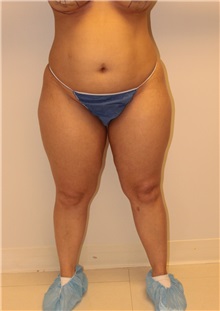 Liposuction Before Photo by Wendell Perry, MD; Doral, FL - Case 27781