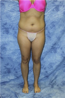 Liposuction Before Photo by Wendell Perry, MD; Alexandria, VA - Case 27782