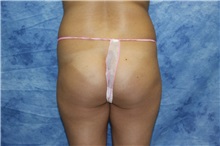 Liposuction Before Photo by Wendell Perry, MD; Alexandria, VA - Case 27782