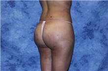 Liposuction After Photo by Wendell Perry, MD; Alexandria, VA - Case 27782