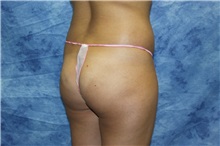 Liposuction Before Photo by Wendell Perry, MD; Alexandria, VA - Case 27782