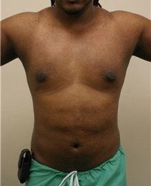 Liposuction After Photo by Wendell Perry, MD; Alexandria, VA - Case 27803