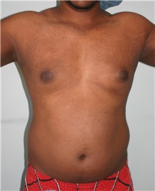 Liposuction Before Photo by Wendell Perry, MD; Alexandria, VA - Case 27803