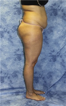 Liposuction Before Photo by Wendell Perry, MD; Doral, FL - Case 27804