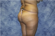 Liposuction Before Photo by Wendell Perry, MD; Doral, FL - Case 27804