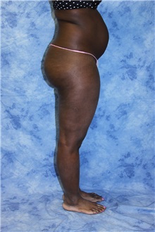 Liposuction Before Photo by Wendell Perry, MD; Alexandria, VA - Case 27805