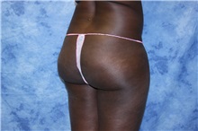 Liposuction Before Photo by Wendell Perry, MD; Alexandria, VA - Case 27805