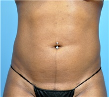 Liposuction After Photo by John Connors, III, MD; Alpharetta, GA - Case 39600