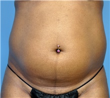 Liposuction Before Photo by John Connors, III, MD; Alpharetta, GA - Case 39600