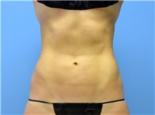 Liposuction After Photo by John Connors, III, MD; Alpharetta, GA - Case 39603