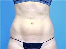 Liposuction Before Photo by John Connors, III, MD; Alpharetta, GA - Case 39603