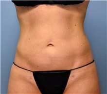 Liposuction After Photo by John Connors, III, MD; Alpharetta, GA - Case 39605