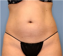 Liposuction Before Photo by John Connors, III, MD; Alpharetta, GA - Case 39605