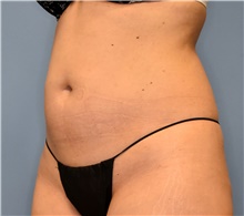 Liposuction Before Photo by John Connors, III, MD; Alpharetta, GA - Case 39605