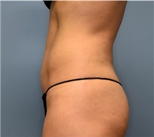 Liposuction After Photo by John Connors, III, MD; Alpharetta, GA - Case 39605