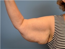 A before and after view of a successful brachioplasty procedure. An untoned  arm is seen on