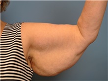Arm Lift Before Photo by John Connors, III, MD; Alpharetta, GA - Case 39701