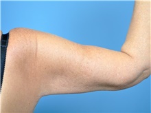 Arm Lift After Photo by John Connors, III, MD; Alpharetta, GA - Case 39701
