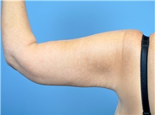 Arm Lift After Photo by John Connors, III, MD; Alpharetta, GA - Case 39701