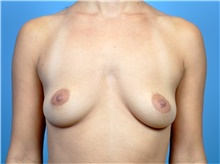 Breast Augmentation Before Photo by John Connors, III, MD; Alpharetta, GA - Case 39702