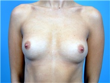 Breast Augmentation Before Photo by John Connors, III, MD; Alpharetta, GA - Case 39703