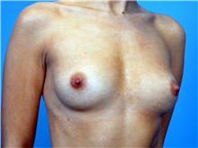 Breast Augmentation Before Photo by John Connors, III, MD; Alpharetta, GA - Case 39703
