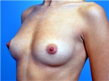 Breast Augmentation Before Photo by John Connors, III, MD; Alpharetta, GA - Case 39703