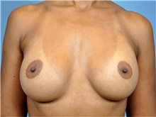 Breast Augmentation After Photo by John Connors, III, MD; Alpharetta, GA - Case 39704