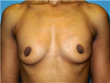 Breast Augmentation Before Photo by John Connors, III, MD; Alpharetta, GA - Case 39704