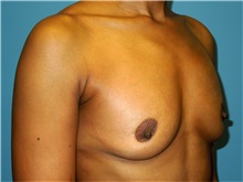 Breast Augmentation Before Photo by John Connors, III, MD; Alpharetta, GA - Case 39704