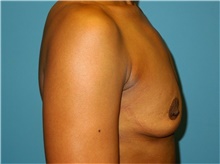 Breast Augmentation Before Photo by John Connors, III, MD; Alpharetta, GA - Case 39704