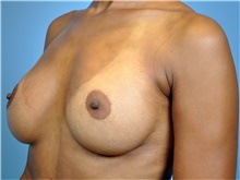 Breast Augmentation After Photo by John Connors, III, MD; Alpharetta, GA - Case 39704
