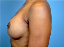 Breast Augmentation After Photo by John Connors, III, MD; Alpharetta, GA - Case 39704