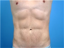 Body Contouring After Photo by John Connors, III, MD; Alpharetta, GA - Case 39705