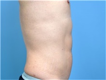 Body Contouring After Photo by John Connors, III, MD; Alpharetta, GA - Case 39705