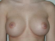 Breast Augmentation After Photo by Edward Love, MD; Little Rock, AR - Case 7066