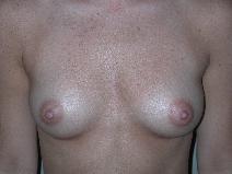 Breast Augmentation Before Photo by Edward Love, MD; Little Rock, AR - Case 7066