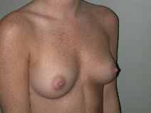 Breast Augmentation Before Photo by Edward Love, MD; Little Rock, AR - Case 7066