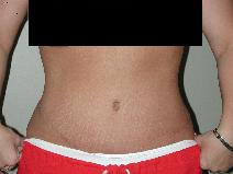 Tummy Tuck After Photo by Edward Love, MD; Little Rock, AR - Case 7068