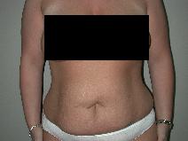 Tummy Tuck Before Photo by Edward Love, MD; Little Rock, AR - Case 7068