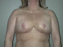 Breast Reduction After Photo by Edward Love, MD; Little Rock, AR - Case 7069