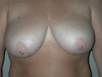 Breast Reduction Before Photo by Edward Love, MD; Little Rock, AR - Case 7069