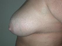 Breast Reduction Before Photo by Edward Love, MD; Little Rock, AR - Case 7069