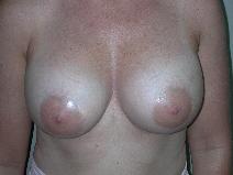 Breast Augmentation After Photo by Edward Love, MD; Little Rock, AR - Case 7070