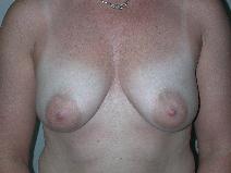 Breast Augmentation Before Photo by Edward Love, MD; Little Rock, AR - Case 7070