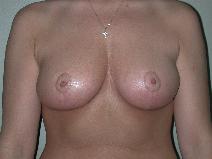 Breast Reduction After Photo by Edward Love, MD; Little Rock, AR - Case 7071